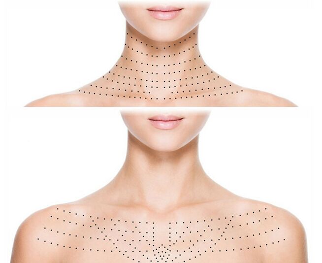 Markierung auf der Haut von Hals und Dekolleté zur Verjüngung der Biorevitalisierung