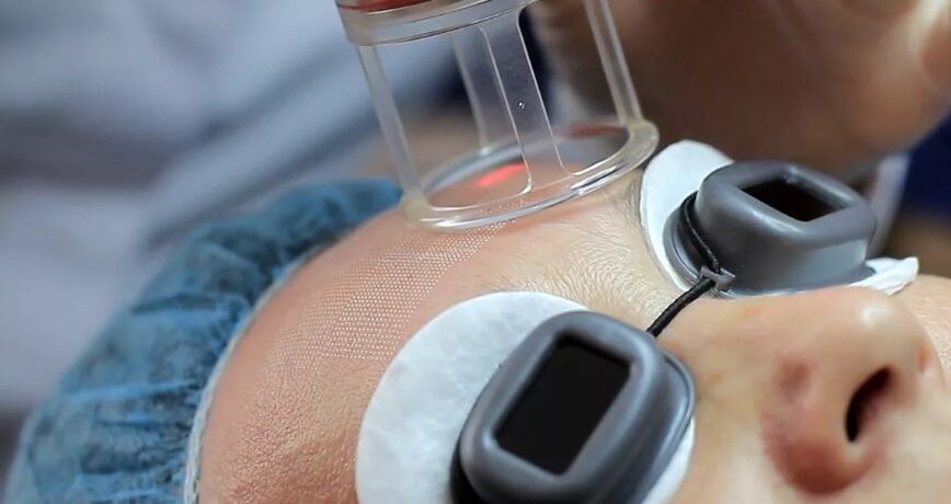 Feldlaser